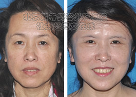 杜太超整形案例