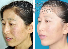 杜太超整形案例